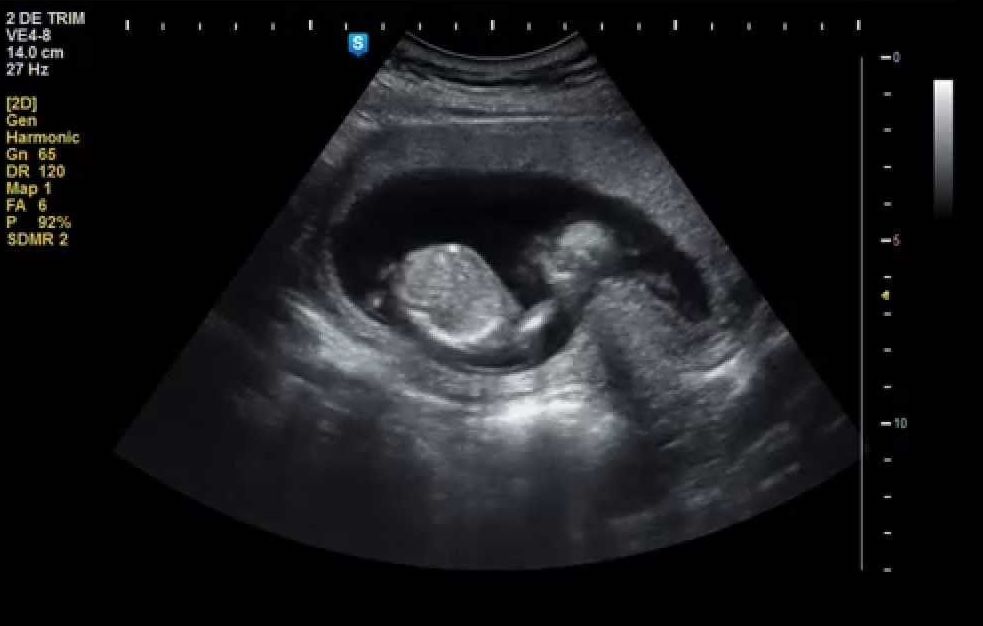 15. hafta gebelik ultrason görüntüsü